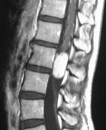 脊髄腫瘍.jpg