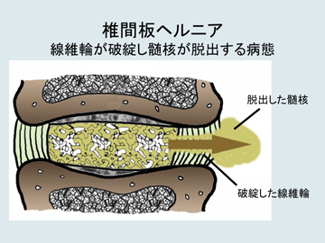 椎間板ヘルニア.jpg