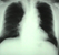 肺.jpg