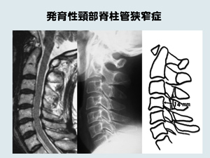 発育性頸部脊柱管狭窄症.jpg