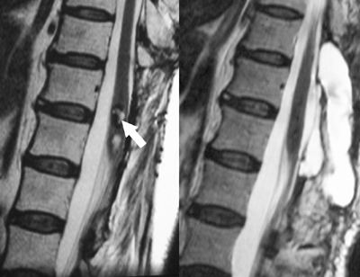 cavernoma.jpg