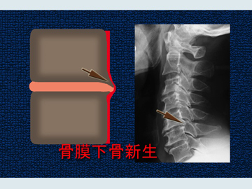 変形性頸椎症.jpg