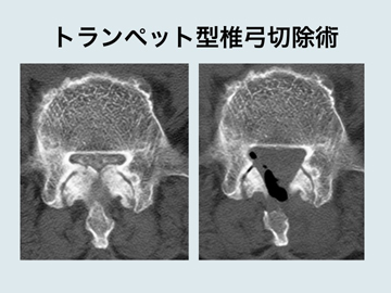 laminectomy.jpg