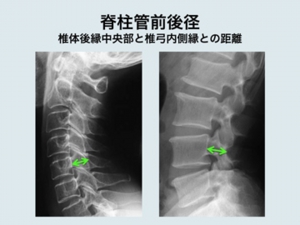 脊柱管前後径.jpg