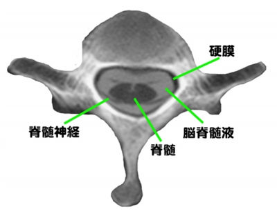 硬膜内.jpg