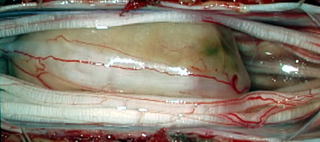 neurinomaoperative.jpg